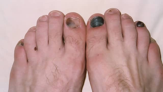 Hairbear's toes after a grueling trek with improper footwear
