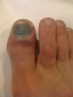 Big toe bruise